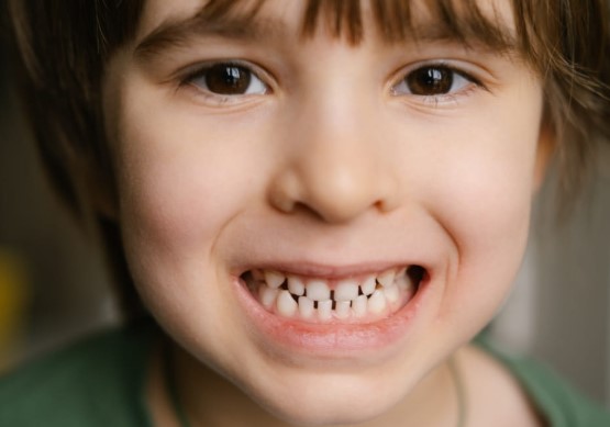 a child showing gapped teeth