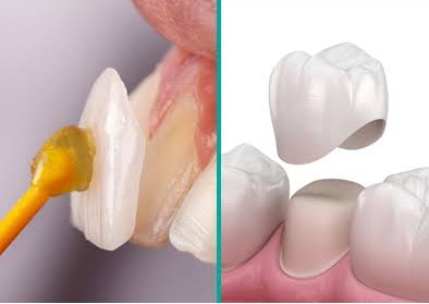 dental veeners vs crowns