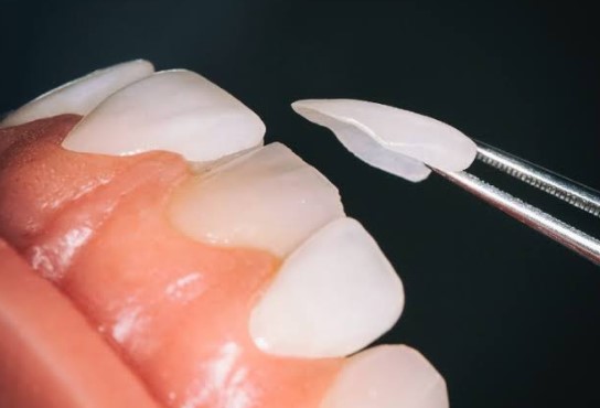 dental veneers being placed on teeth