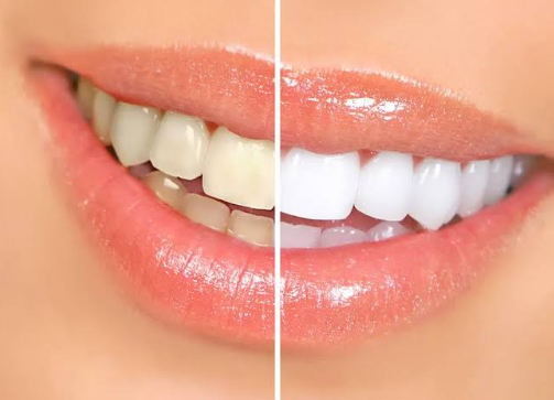 teeth whitening before and after image