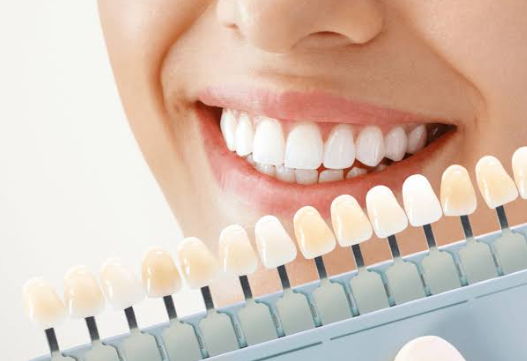 dentist check teeth shades before teeth whitening tarzana