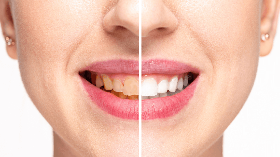 Can Your Diet Impact Your Teeth? Dr. Nargiz I. Zadeh