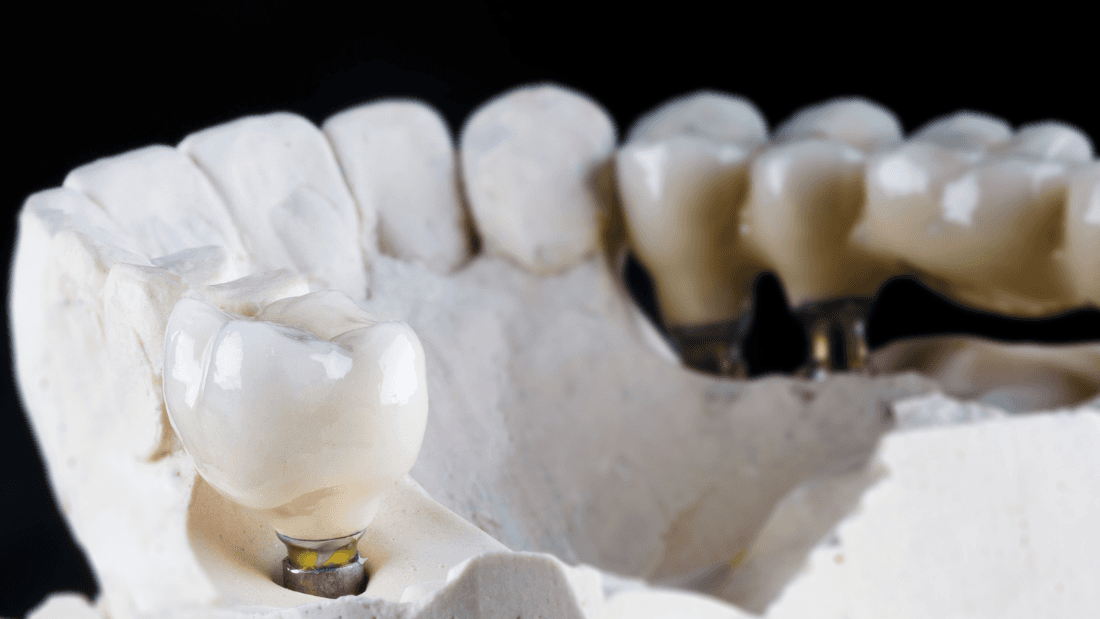 How Long Do Dental Bridges Last? Tips for Maximizing Their Lifespan ...