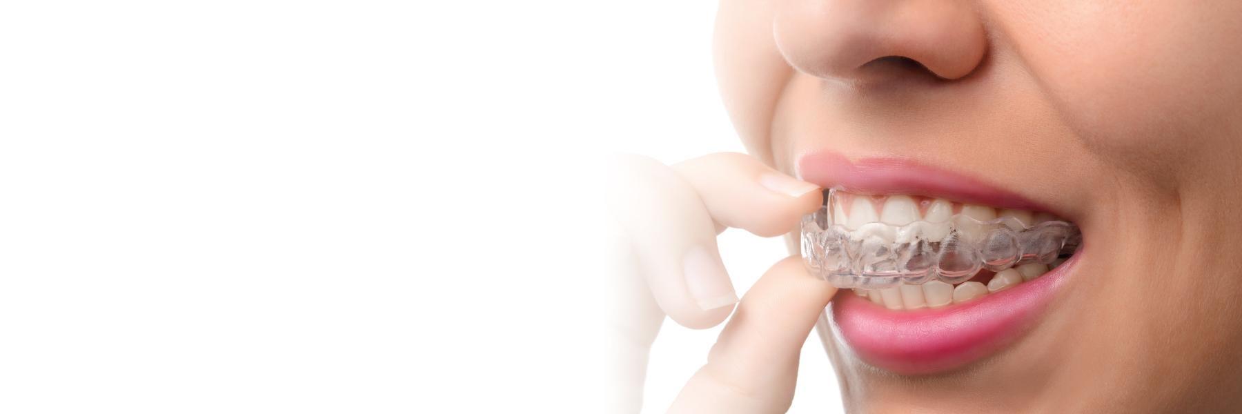 Invisalign Clear Braces