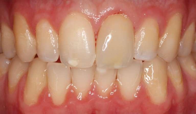 Porcelain-Crown-After-Image