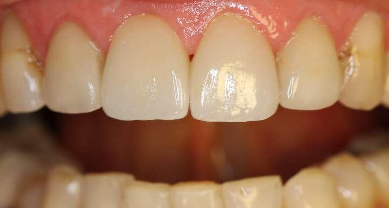 Porcelain-Crowns-After-Image
