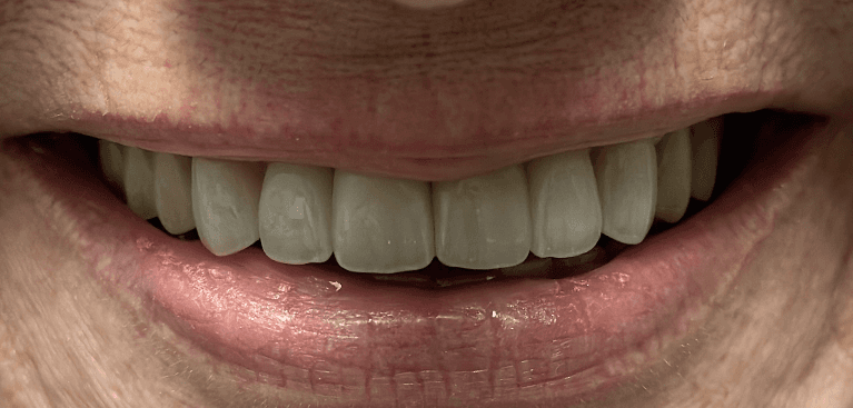 Crowns-Veneers-and-Implant-After-Image