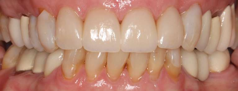 Veneers-After-Image