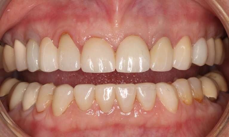 Porcelain-Crowns-and-Bridge-After-Image