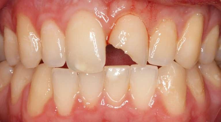 Porcelain-Crown-Before-Image