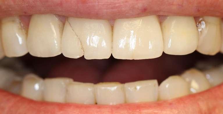 Porcelain-Crowns-Before-Image