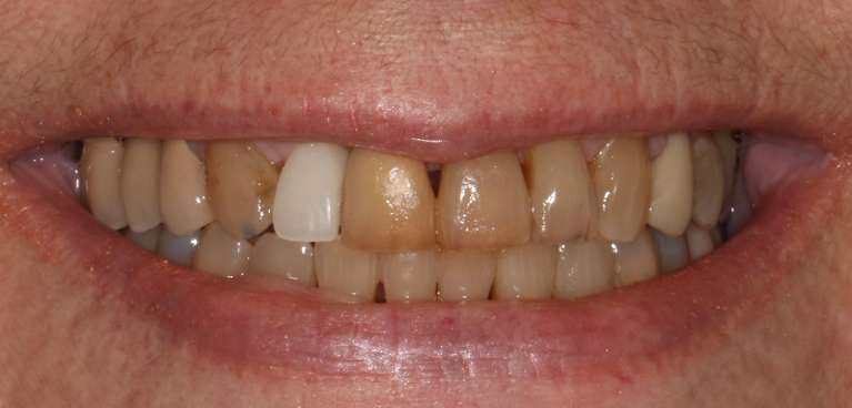 Crowns-Veneers-and-Implant-Before-Image
