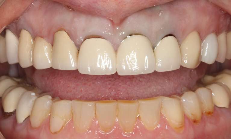 Porcelain-Crowns-and-Bridge-Before-Image