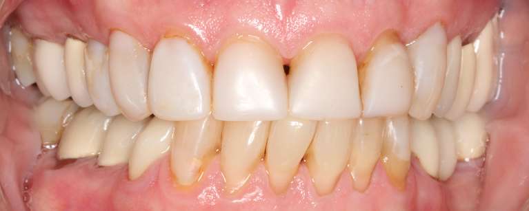 Veneers-Before-Image